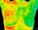 Thermal Breast Screening Marbella