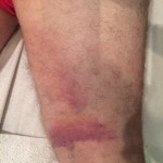 Carlos' leg post treatment