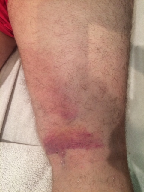 Carlos' leg post treatment