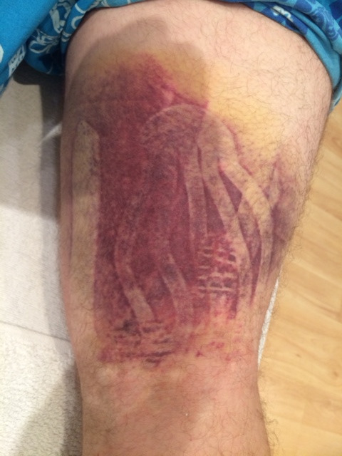 The bruise!