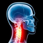 Neck injuries and problems can cause migraines and headaches