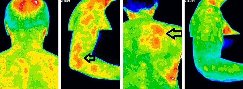 Using thermal imaging for an accurate diagnosis of tennis elbow