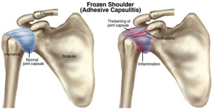 Frozen Shoulder