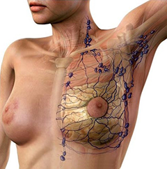 Lymphatic Drainage after breast surgery