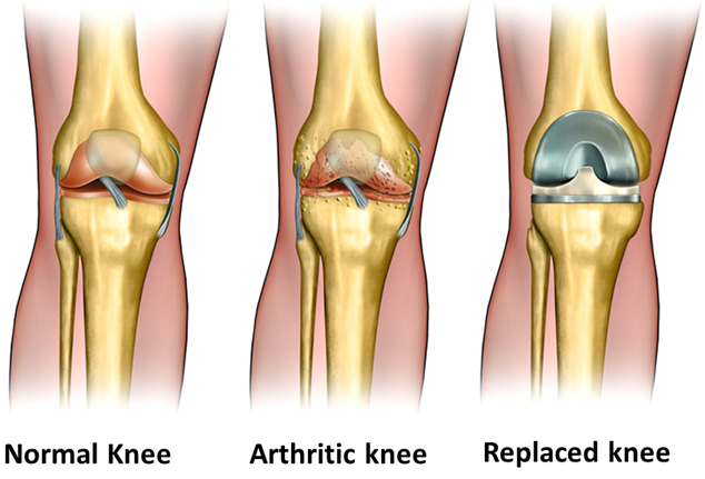 Knee surgery - total knee replacement, arthroscopy, ACL - getting a good result