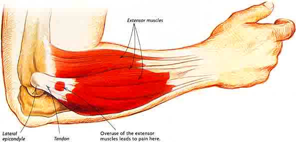 Tennis Elbow - often misdiagnosed and mistreated with cortical steroid injections