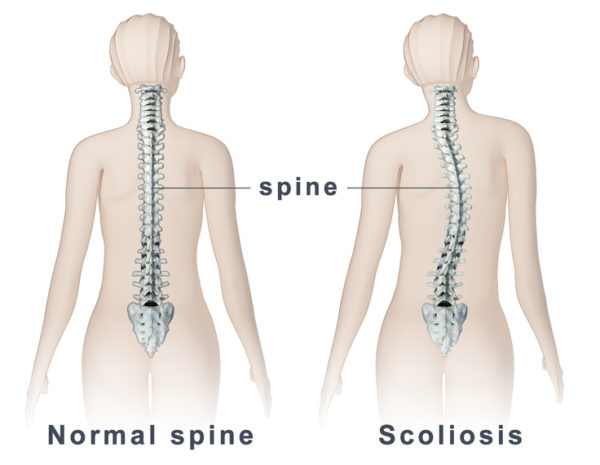 Scoliosis - What to look for