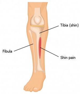 Shin Splint pain location