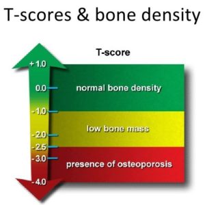 T-Scores for a bone density test - low scores suggest MBST / MRT