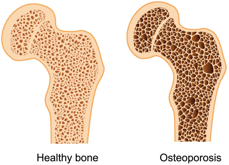 Osteoporosis and Magnetic Resonance Therapy