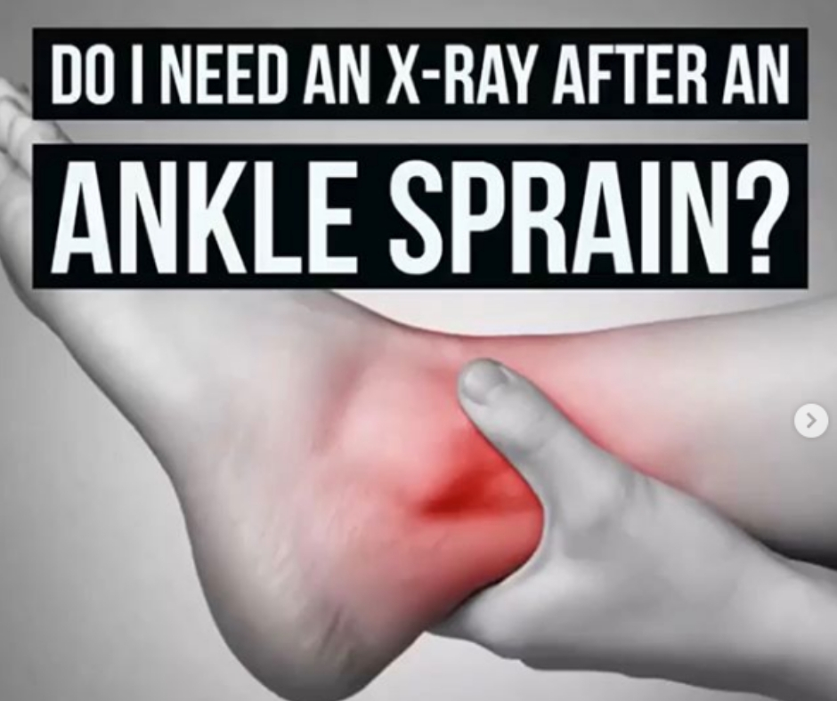 Ankle Sprain - X ray or not