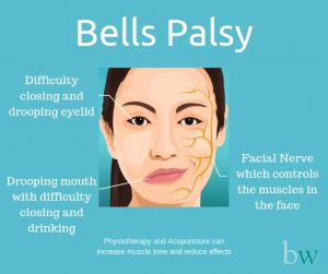 palsy facial nerve bell face anatomy clinical drop bells physiology function idiopathic importance