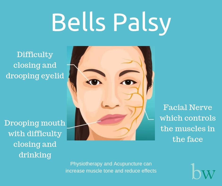 Bells Palsy - physiotherapy and acupuncture can reduce effects